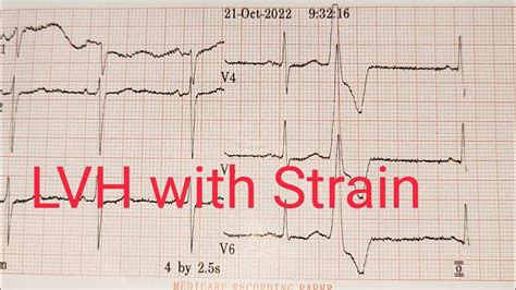 lvh strain pattern ecg|lvh strain pattern vs ischemia.